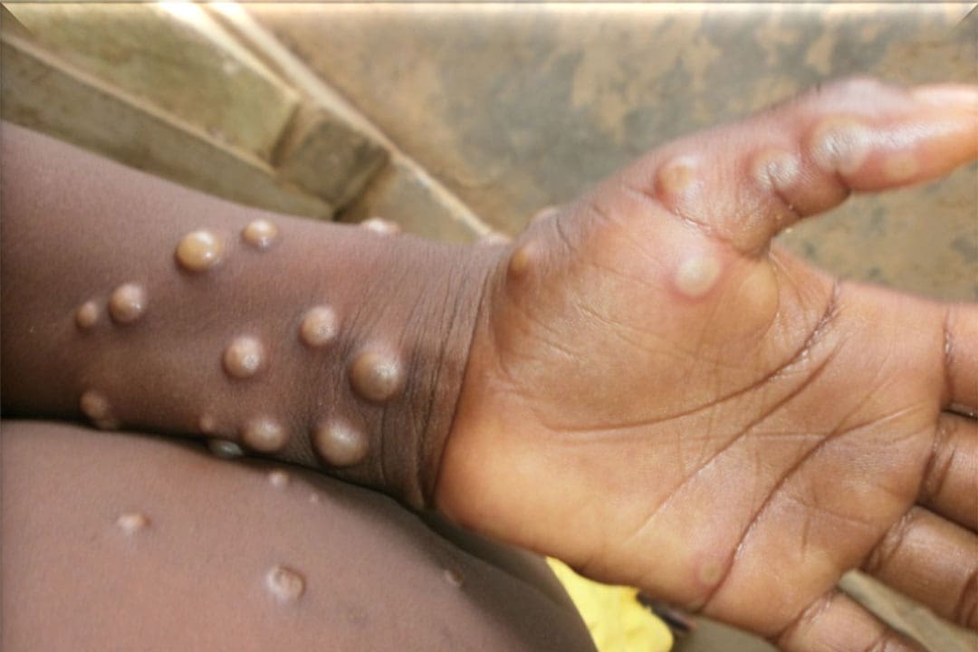 Mpox image.jpeg